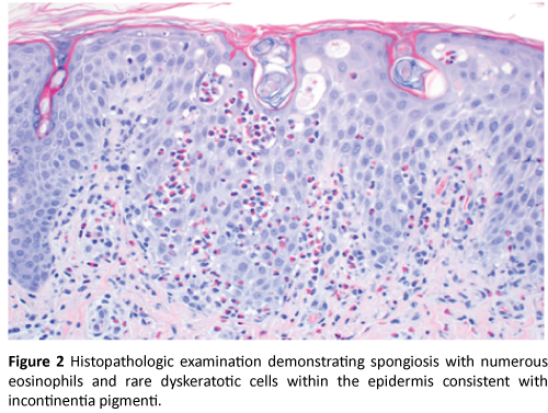 clinical-pediatrics-dermatology-Histopathologic-examination-demonstrating