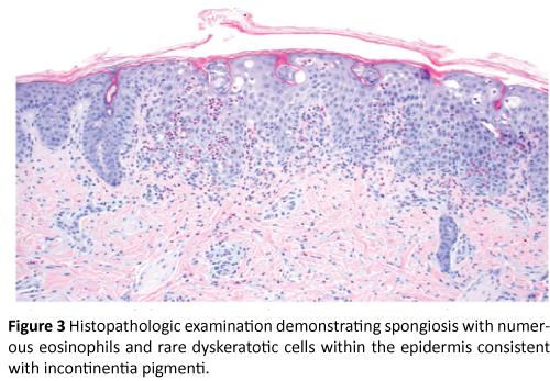 clinical-pediatrics-dermatology-Histopathologic-spongiosis-numerous