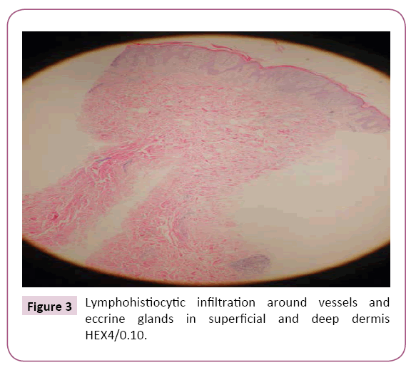 clinical-pediatrics-dermatology-Lymphohistiocytic-infiltration