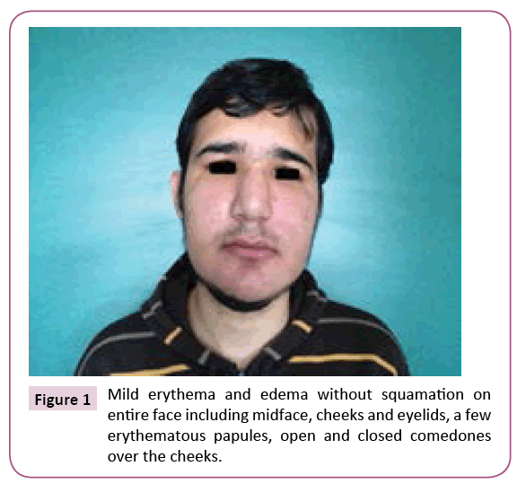 clinical-pediatrics-dermatology-Mild-erythema