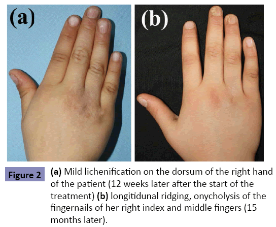clinical-pediatrics-dermatology-Mild-lichenification-dorsum