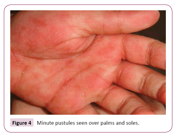 clinical-pediatrics-dermatology-Minute-pustules