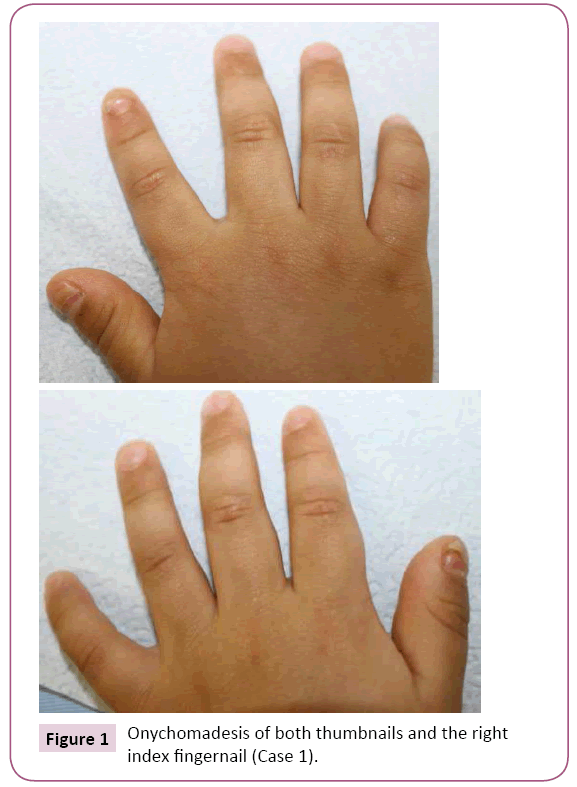 clinical-pediatrics-dermatology-Onychomadesis