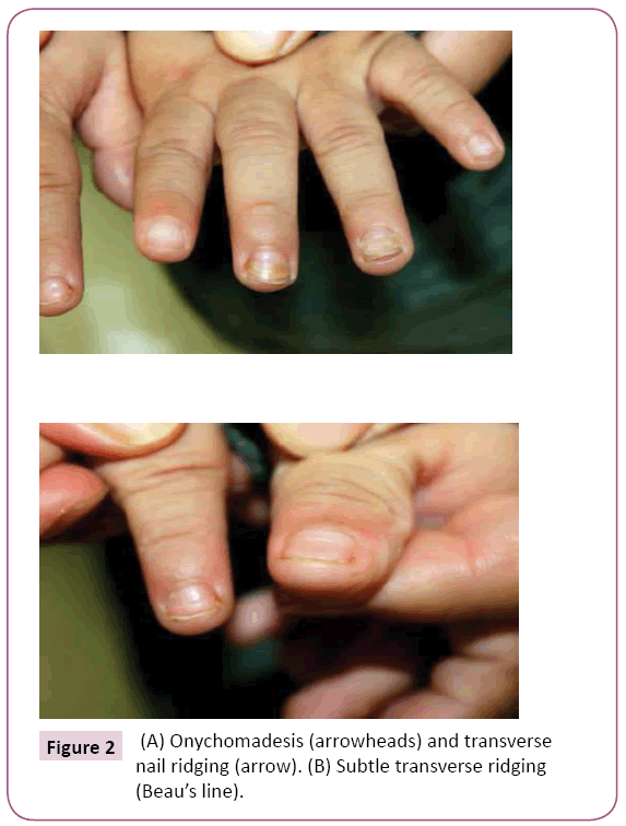 clinical-pediatrics-dermatology-Onychomadesis