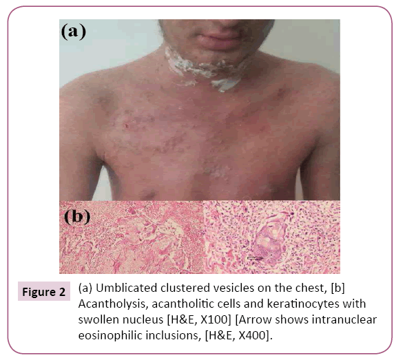 clinical-pediatrics-dermatology-Umblicated-clustered