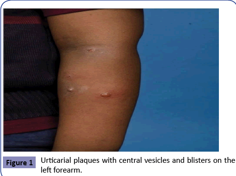 clinical-pediatrics-dermatology-Urticarial-plaques-vesicles
