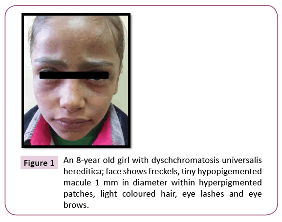 clinical-pediatrics-dermatology-dyschchromatosis-universalis