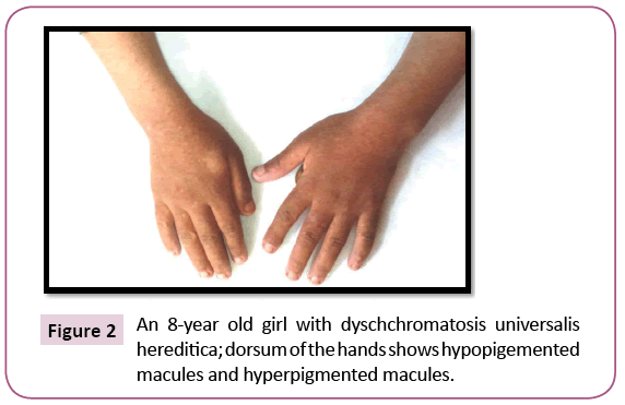 clinical-pediatrics-dermatology-dyschchromatosis-universalis
