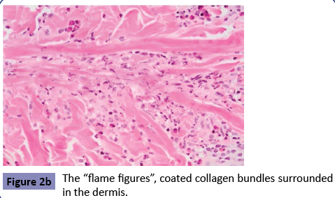 clinical-pediatrics-dermatology-flame-collagen-bundles