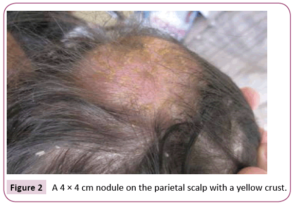 clinical-pediatrics-dermatology-parietal-scalp