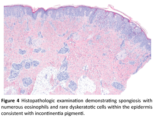 clinical-pediatrics-dermatology-spongiosis-eosinophils-dyskeratotic