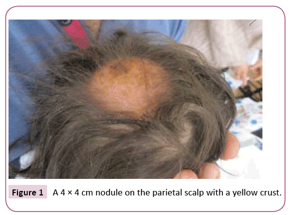 clinical-pediatrics-dermatology-yellow-crust