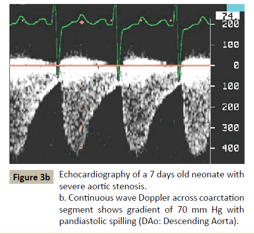 criticalcare-Doppler-across