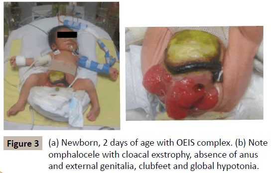 criticalcare-Note-omphalocele