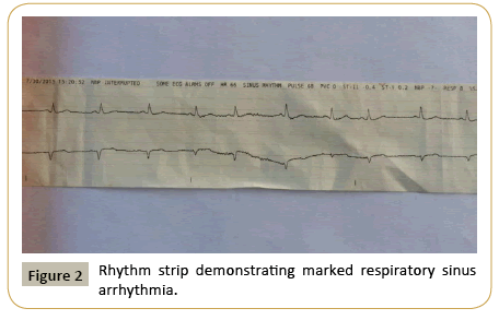 criticalcare-Rhythm-strip-demonstrating