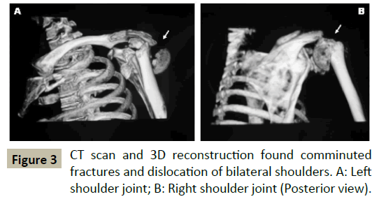 criticalcare-Right-shoulder