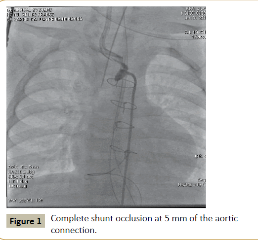 criticalcare-aortic-connection