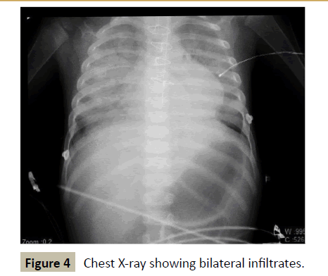 criticalcare-bilateral-infiltrates