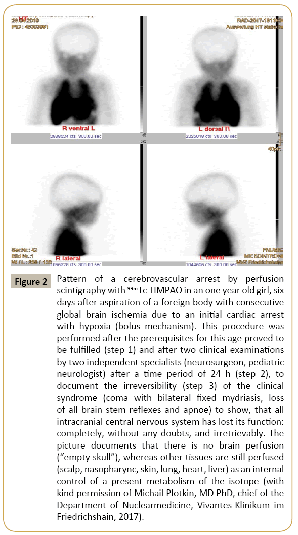 criticalcare-brain-ischemia