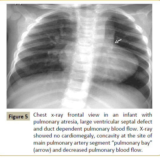 criticalcare-cardiomegaly-concavity