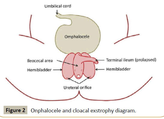 criticalcare-cloacal-exstrophy