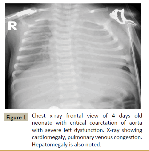 criticalcare-critical-coarctation