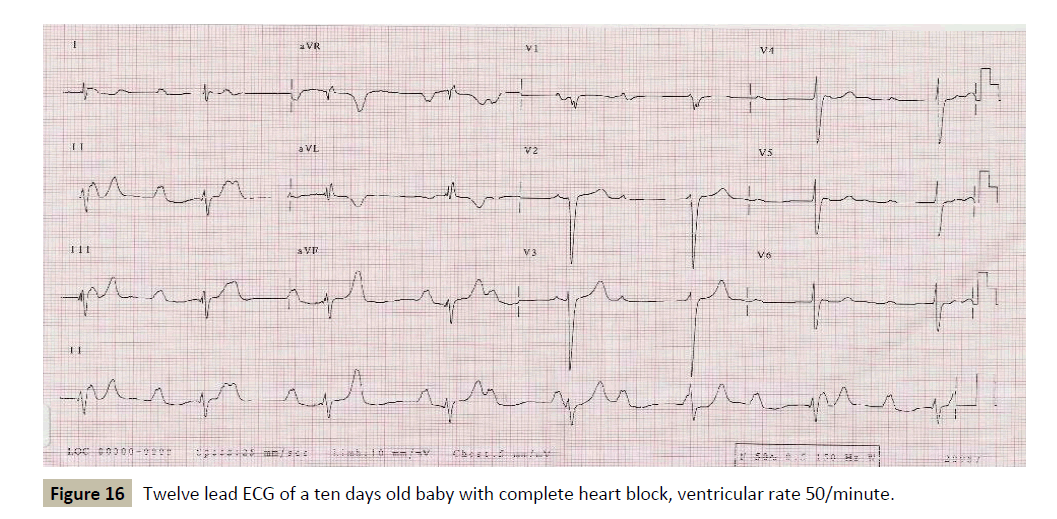 criticalcare-heart-block