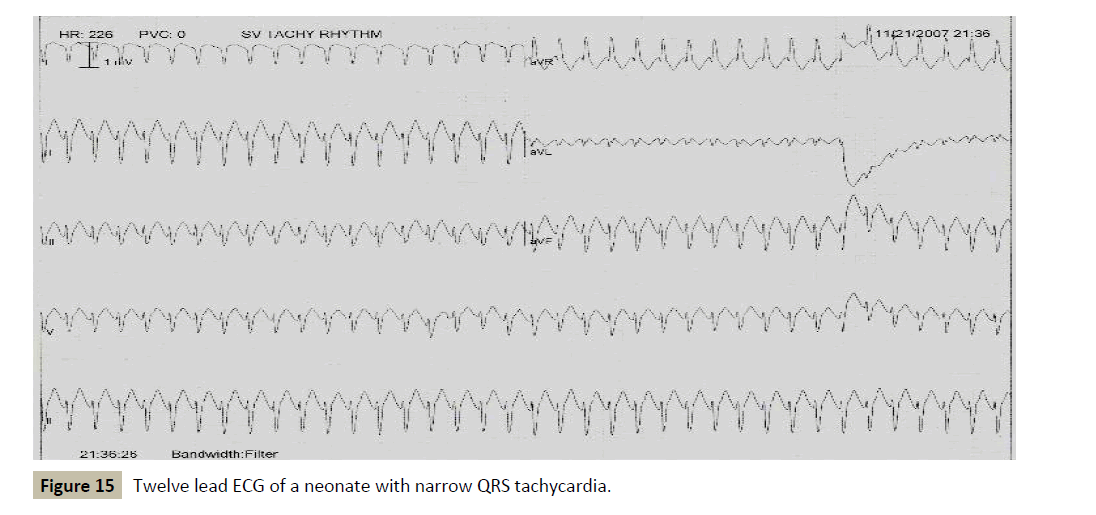 criticalcare-narrow-tachycardia