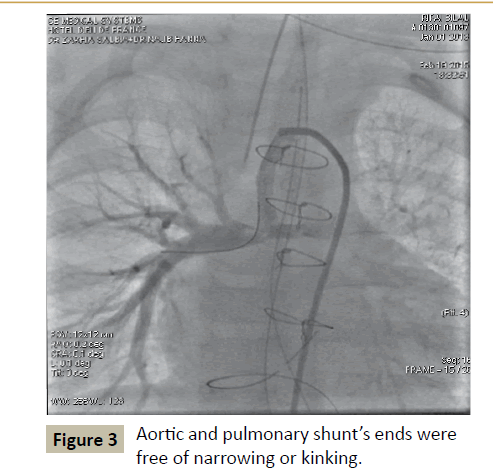 criticalcare-narrowing-kinking