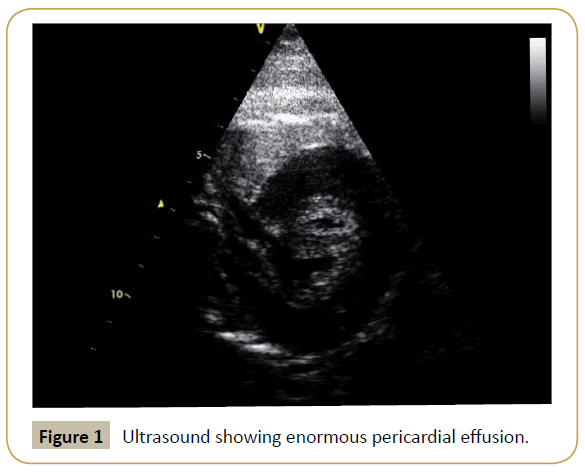 criticalcare-pericardial-effusion