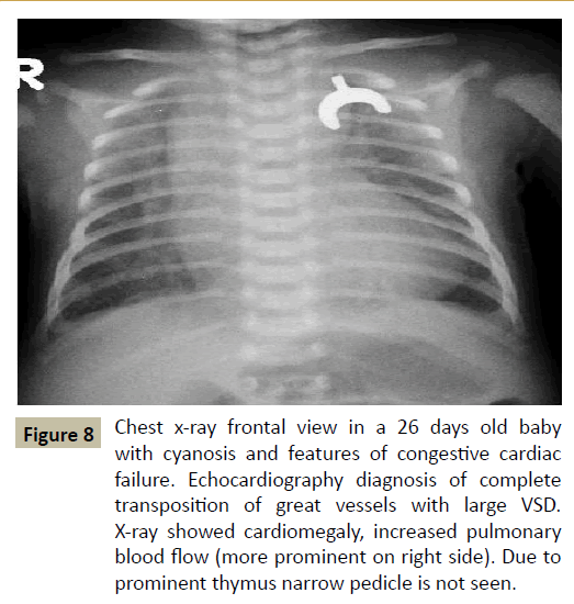 criticalcare-prominent-thymus