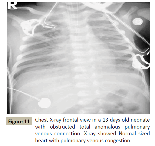criticalcare-pulmonary-venous