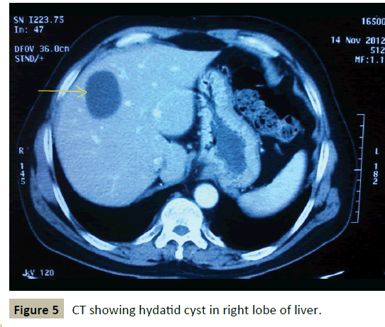 criticalcare-right-lobe