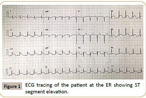 criticalcare-segment-elevation