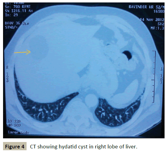 criticalcare-showing-hydatid