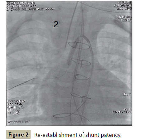 criticalcare-shunt-patency