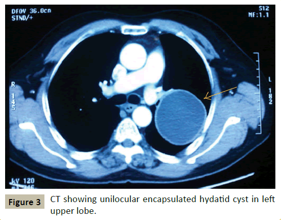 criticalcare-unilocular-encapsulated