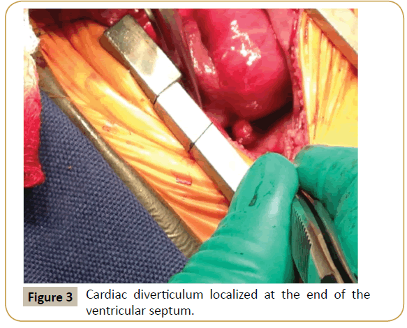criticalcare-ventricular-septum