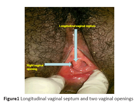 diversityhealthcare-Longitudinal-vaginal-septum