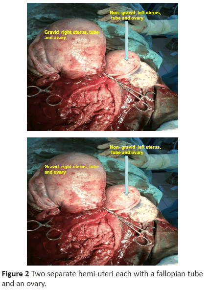 diversityhealthcare-Two-separate-hemi-uteri