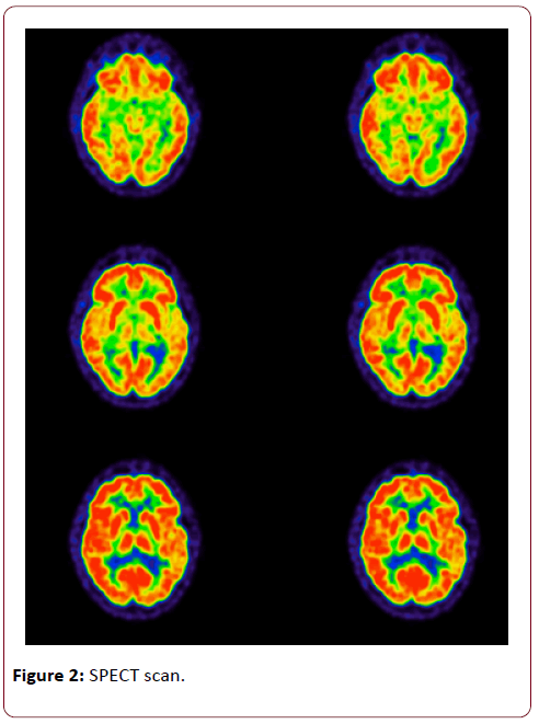 dual-diagnosis-SPECT-scan