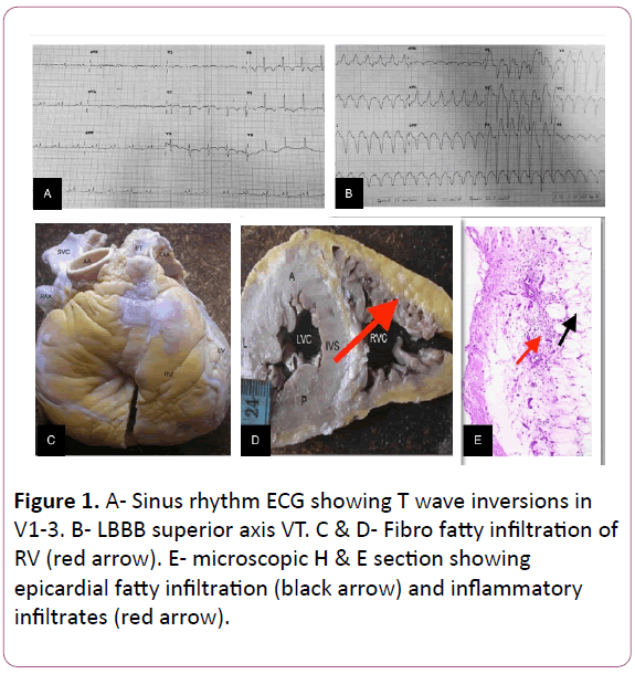 experimental-optical-LBBB-superior-axis