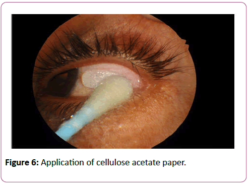 eye-cataract-surgery-Application-cellulose