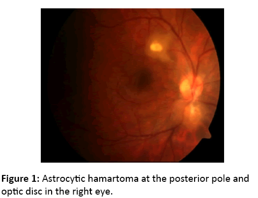 eye-cataract-surgery-Astrocytic-hamartoma