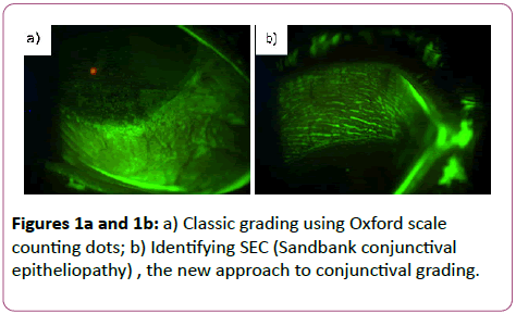 eye-cataract-surgery-Classic-grading