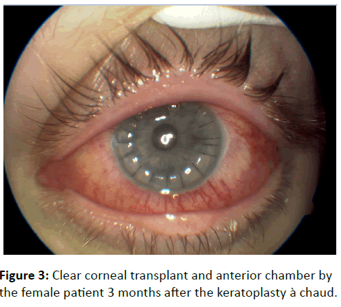 eye-cataract-surgery-Clear-corneal-transplant