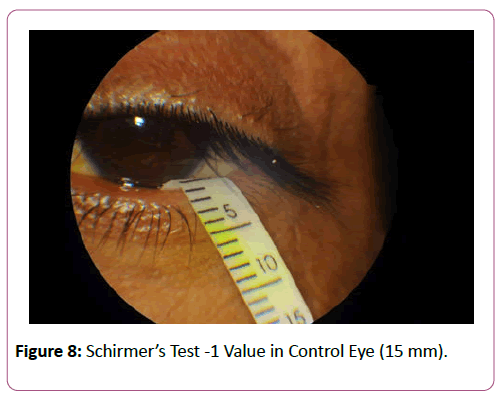 eye-cataract-surgery-Control-Eye