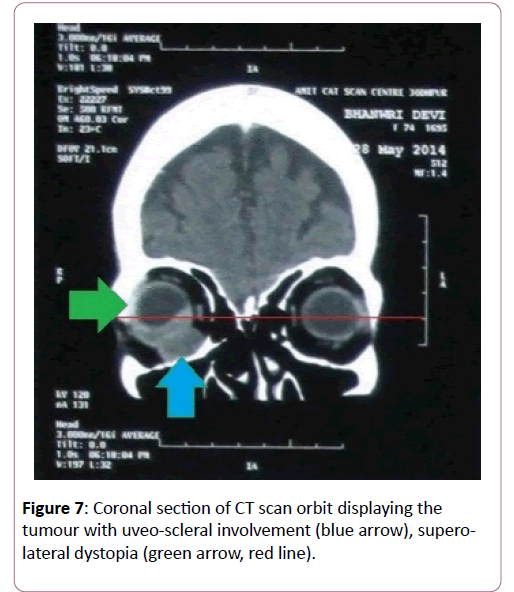 eye-cataract-surgery-Coronal-section