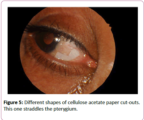 eye-cataract-surgery-Different-shapes