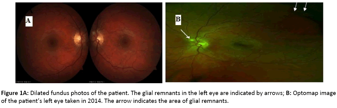 eye-cataract-surgery-Dilated-fundus-photos-patient